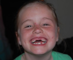 Lost 6th tooth